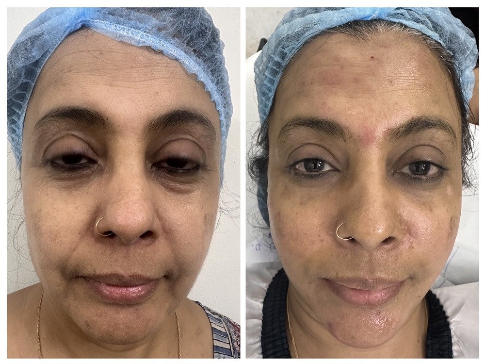  dermal fillers before and after 